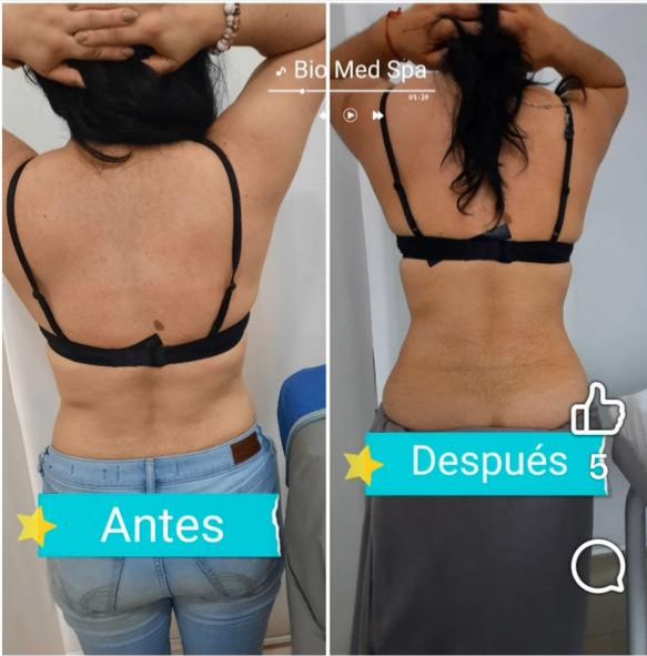 Reducción de Medidas — Espalda