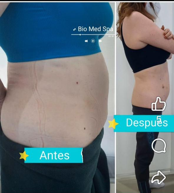 Reducción de Medidas — Abdomen Lateral