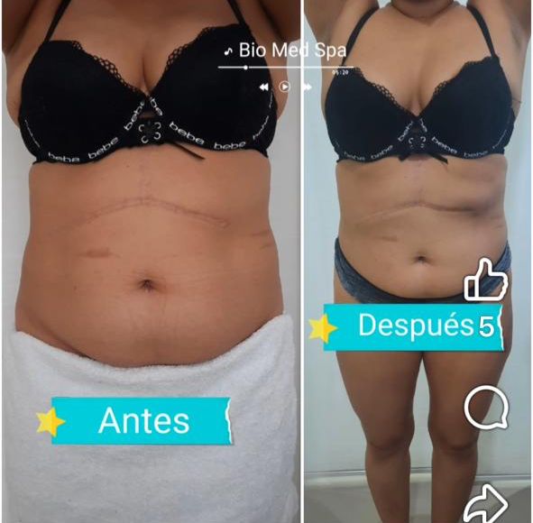Reducción de Medidas — Abdomen Completo