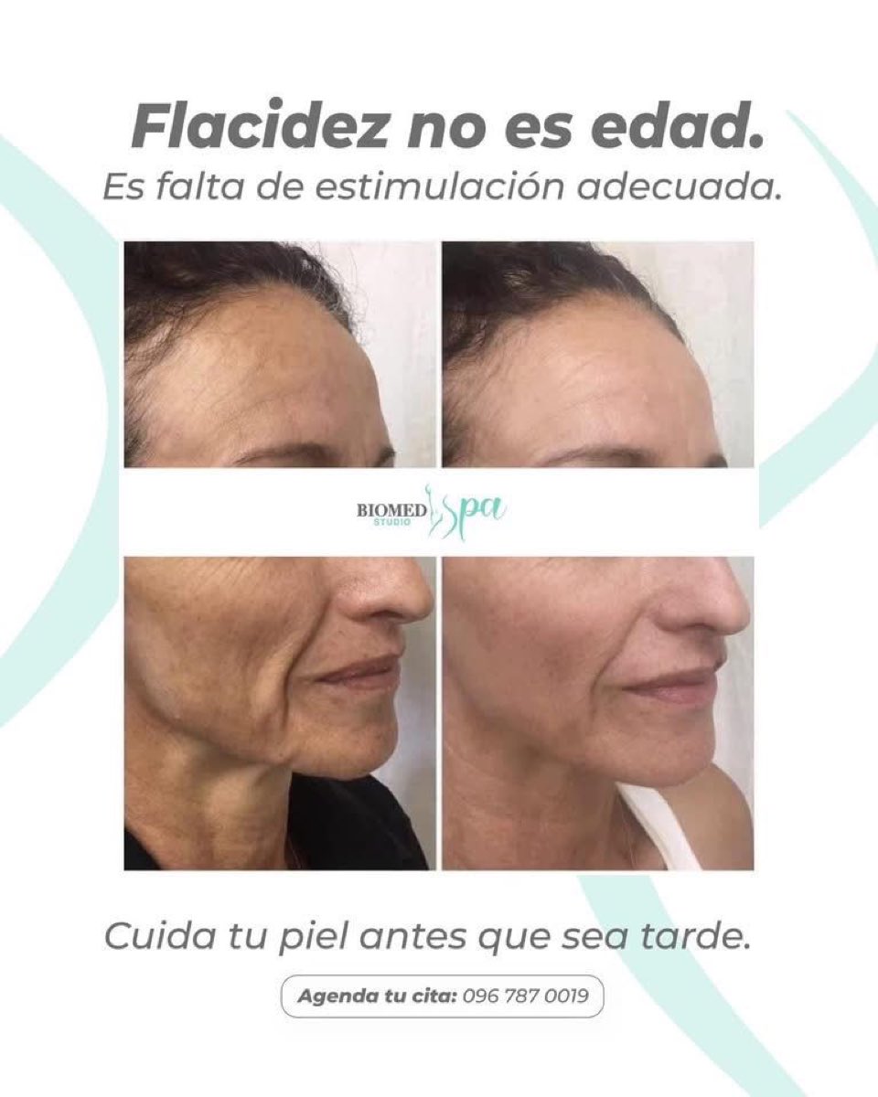 Tratamientos para Flacidez Corporal